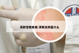 泽肤雪银屑病 泽银洗剂是什么