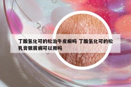 丁酸氢化可的松治牛皮癣吗 丁酸氢化可的松乳膏银屑病可以用吗