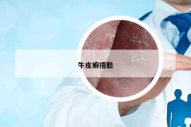 牛皮癣捂脸