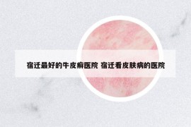 宿迁最好的牛皮癣医院 宿迁看皮肤病的医院