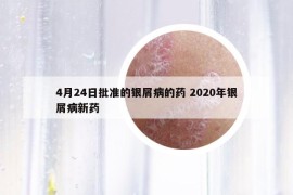 4月24日批准的银屑病的药 2020年银屑病新药