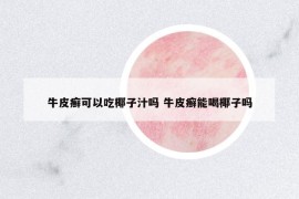 牛皮癣可以吃椰子汁吗 牛皮癣能喝椰子吗