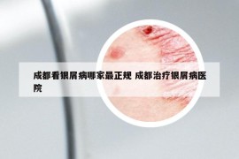 成都看银屑病哪家最正规 成都治疗银屑病医院