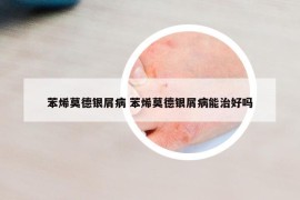 苯烯莫德银屑病 苯烯莫德银屑病能治好吗