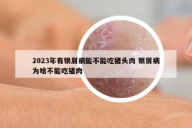 2023年有银屑病能不能吃猪头肉 银屑病为啥不能吃猪肉