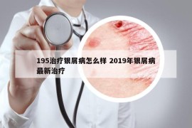 195治疗银屑病怎么样 2019年银屑病最新治疗