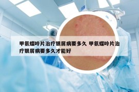 甲氨蝶呤片治疗银屑病要多久 甲氨蝶呤片治疗银屑病要多久才能好