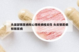 头面部银屑病和心理疾病相关性 头皮银屑病和银屑病