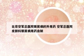 北京空军总医院银屑病的外用药 空军总医院皮肤科银屑病用药自制