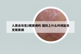 人类会攻克2银屑病吗 国际上什么时候能攻克银屑病