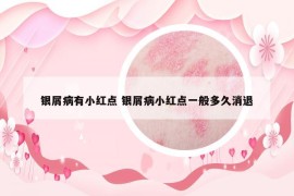 银屑病有小红点 银屑病小红点一般多久消退
