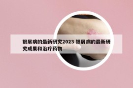 银屑病的最新研究2023 银屑病的最新研究成果和治疗药物