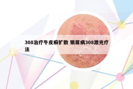 308治疗牛皮癣扩散 银屑病308激光疗法