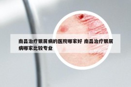 南昌治疗银屑病的医院哪家好 南昌治疗银屑病哪家比较专业