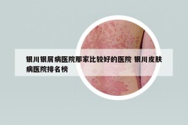 银川银屑病医院那家比较好的医院 银川皮肤病医院排名榜