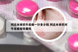阿达木单抗牛皮癣一针多少钱 阿达木单抗对牛皮癣有效果吗