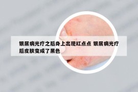 银屑病光疗之后身上出现红点点 银屑病光疗后皮肤变成了黑色