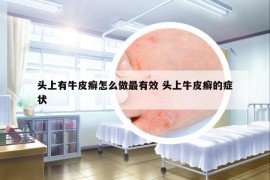 头上有牛皮癣怎么做最有效 头上牛皮癣的症状