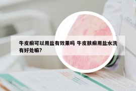 牛皮癣可以用盐有效果吗 牛皮肤癣用盐水洗有好处嘛?