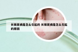 长银屑病是怎么引起的 长银屑病是怎么引起的原因