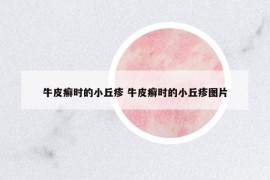 牛皮癣时的小丘疹 牛皮癣时的小丘疹图片
