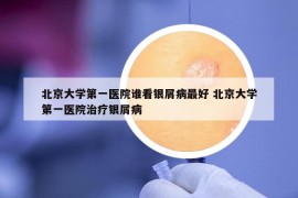 北京大学第一医院谁看银屑病最好 北京大学第一医院治疗银屑病