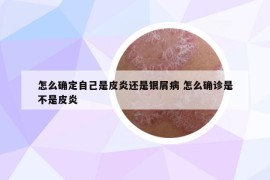 怎么确定自己是皮炎还是银屑病 怎么确诊是不是皮炎