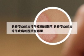 长春专业的治疗牛皮癣的医院 长春专业的治疗牛皮癣的医院在哪里