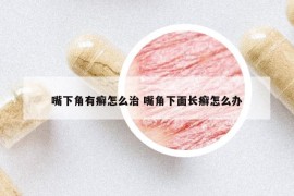 嘴下角有癣怎么治 嘴角下面长癣怎么办