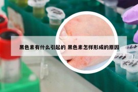 黑色素有什么引起的 黑色素怎样形成的原因