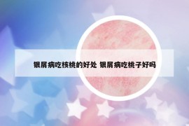 银屑病吃核桃的好处 银屑病吃桃子好吗