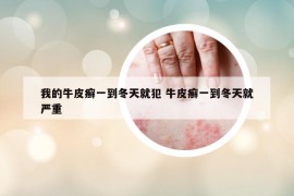 我的牛皮癣一到冬天就犯 牛皮癣一到冬天就严重
