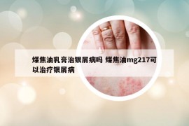 煤焦油乳膏治银屑病吗 煤焦油mg217可以治疗银屑病