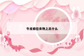 牛皮癣在食物上忌什么