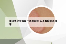 请问头上有癣是什么原因呀 头上有癣怎么回事