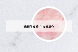 焦彬牛皮癣 牛皮癣简介