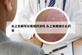 头上长癣可以用绿药膏吗 头上有癣抹什么药膏