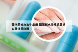 醋泡花椒水治牛皮癣 醋花椒水治疗银屑病 白醋还是陈醋