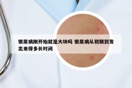 银屑病刚开始就是大块吗 银屑病从初期到发出来得多长时间