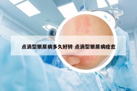 点滴型银屑病多久好转 点滴型银屑病痊愈
