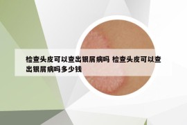 检查头皮可以查出银屑病吗 检查头皮可以查出银屑病吗多少钱
