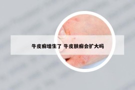 牛皮癣增生了 牛皮肤癣会扩大吗