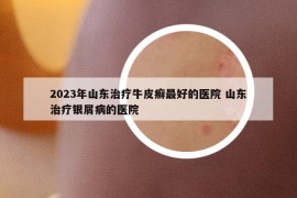 2023年山东治疗牛皮癣最好的医院 山东治疗银屑病的医院