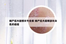 顺产后大腿根长牛皮癣 顺产后大腿根部长白色的痘痘