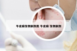 牛皮癣生物制剂类 牛皮癣 生物制剂
