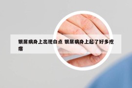 银屑病身上出现白点 银屑病身上起了好多疙瘩