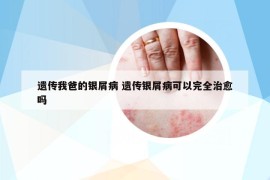 遗传我爸的银屑病 遗传银屑病可以完全治愈吗