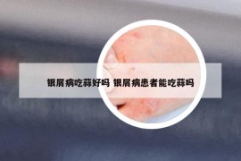 银屑病吃蒜好吗 银屑病患者能吃蒜吗