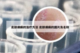 皮肤病癣的治疗方法 皮肤病癣的图片及名称