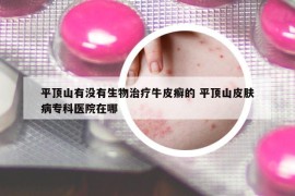 平顶山有没有生物治疗牛皮癣的 平顶山皮肤病专科医院在哪